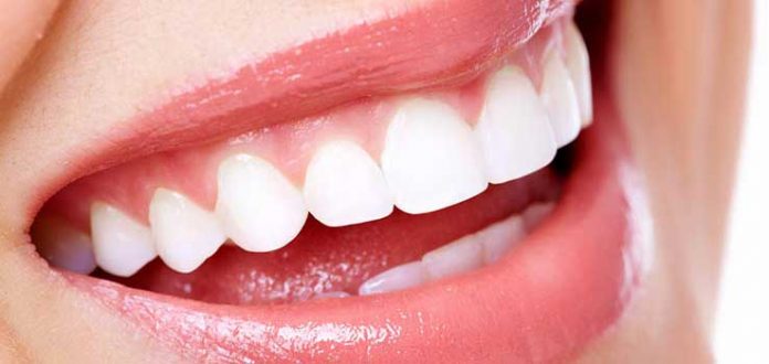 Diş Beyazlatma (Bleaching)