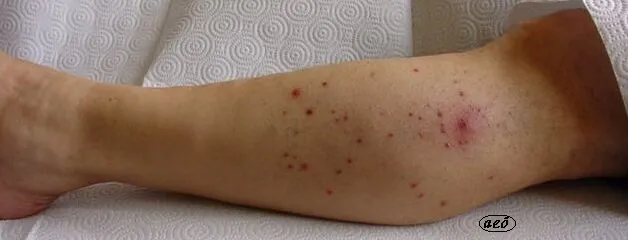 Vezikül Nedir? Deride Su Toplaması (Kabarcık) Nedenleri