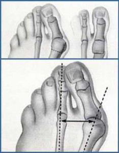 Valgus Deformitesi